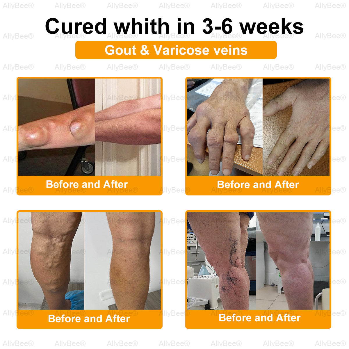 AllyBee™ Botulinum Toxin & Bee Venom Pain-Relief Bone Healing Cream
