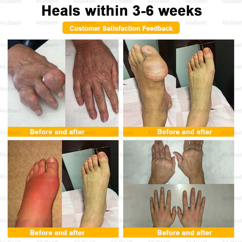 AllyBee™ Botulinum Toxin & Bee Venom Pain-Relief Bone Healing Cream