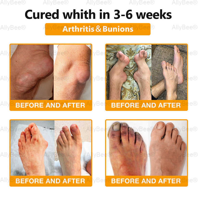 AllyBee™ Botulinum Toxin & Bee Venom Pain-Relief Bone Healing Cream