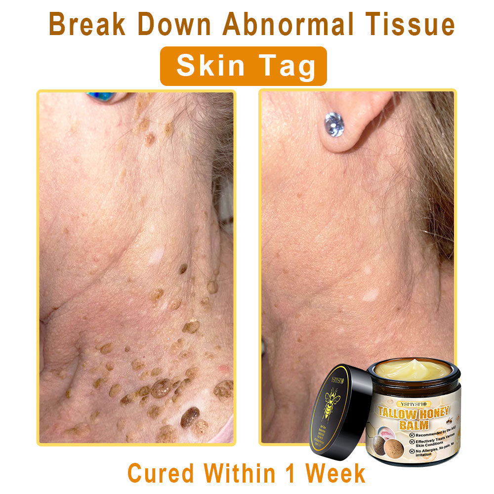 YSMYSM® Bee Venom and Tallow Comprehensive Cream: Anti-Aging, Hydration, Skin Repair, Even Tone, Acne & Dark Spot Treatment, Wart & Mole Removal, Psoriasis Relief