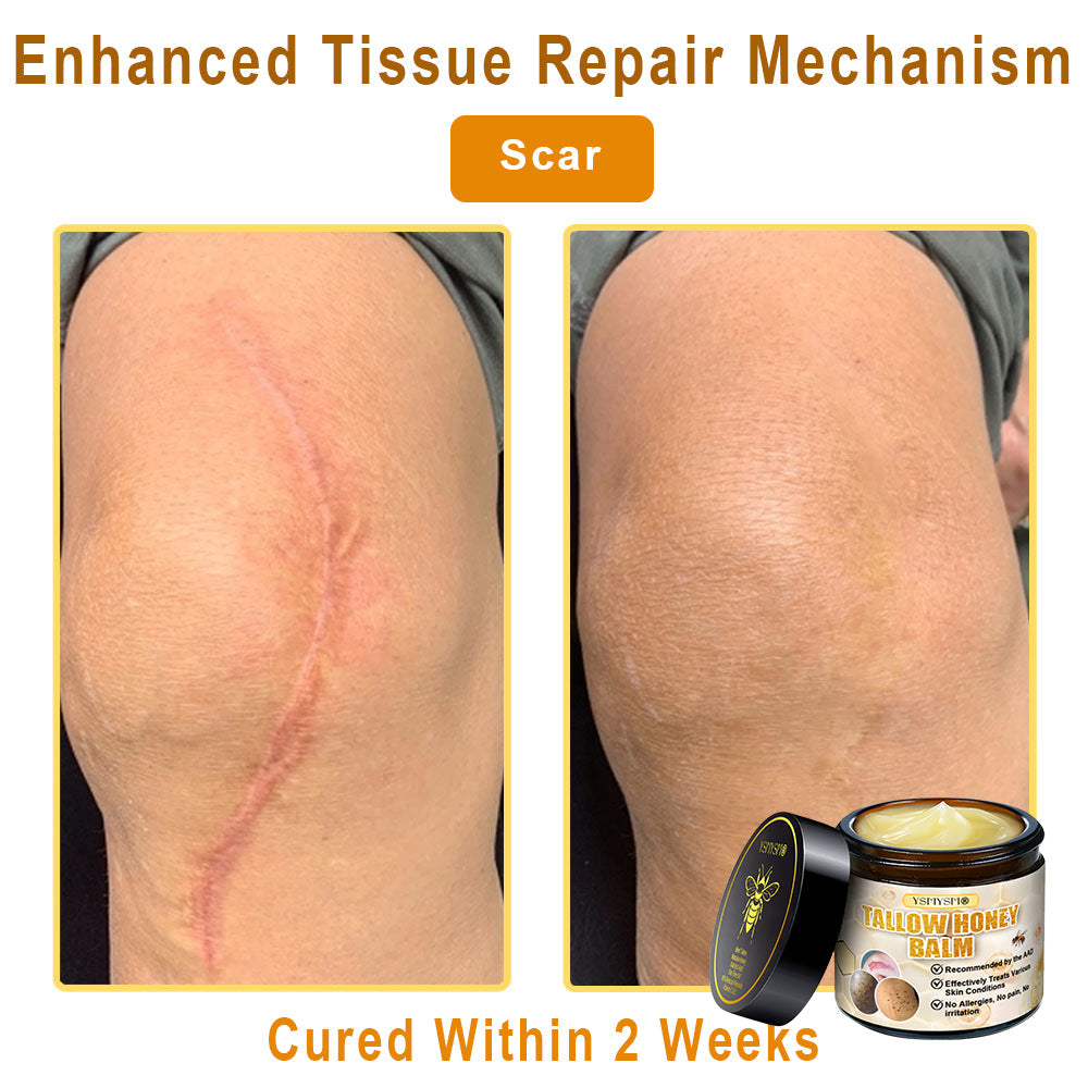 YSMYSM® Bee Venom and Tallow Comprehensive Cream: Anti-Aging, Hydration, Skin Repair, Even Tone, Acne & Dark Spot Treatment, Wart & Mole Removal, Psoriasis Relief