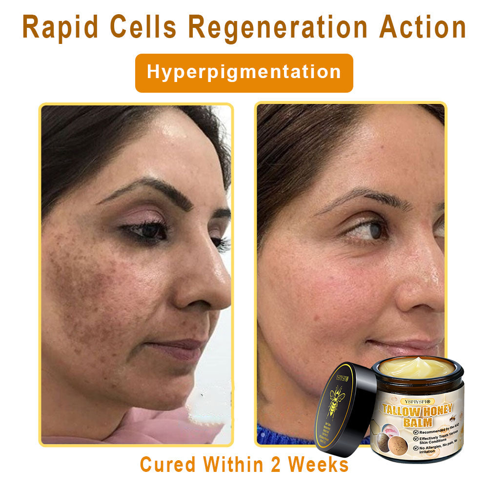 YSMYSM® Bee Venom and Tallow Comprehensive Cream: Anti-Aging, Hydration, Skin Repair, Even Tone, Acne & Dark Spot Treatment, Wart & Mole Removal, Psoriasis Relief