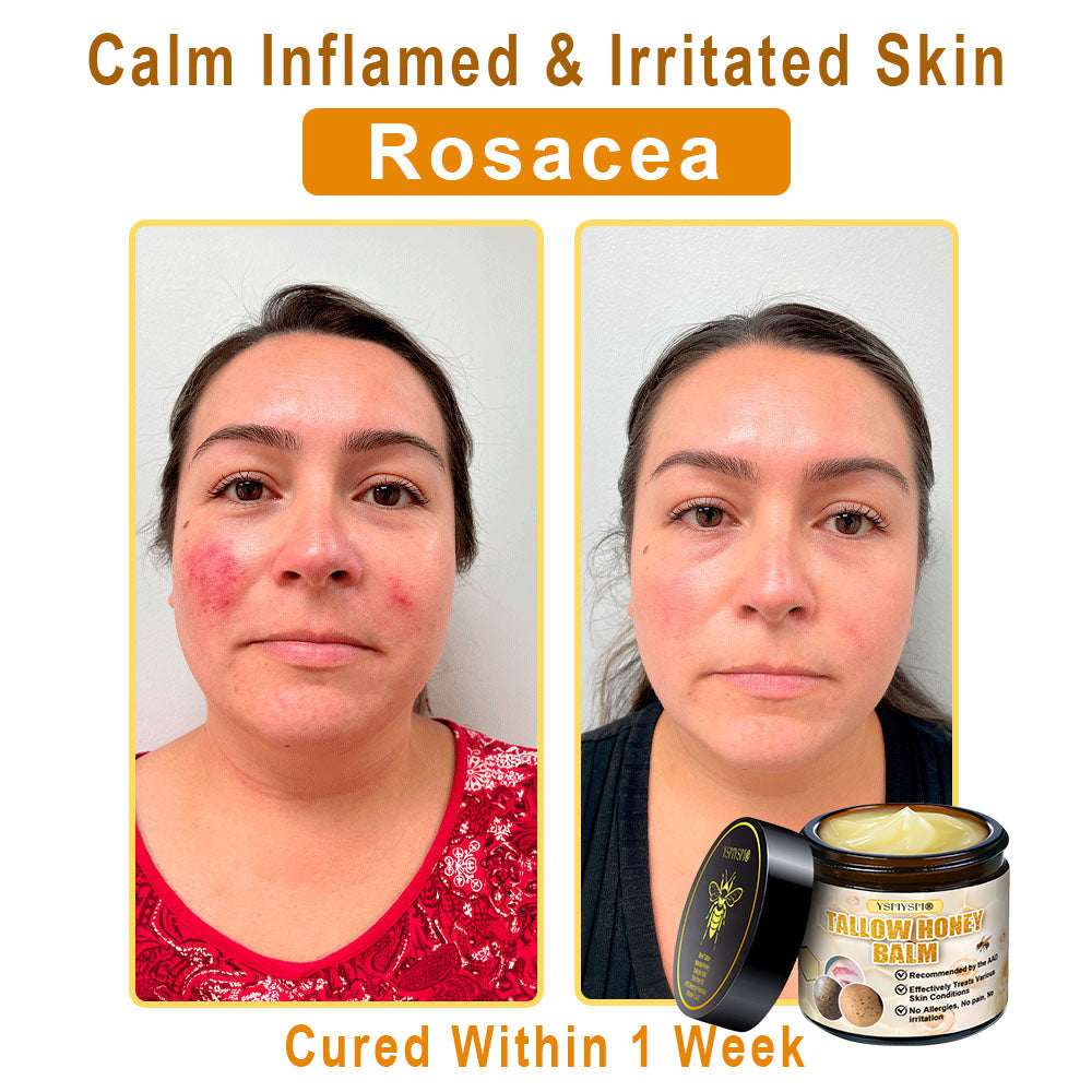 YSMYSM® Bee Venom and Tallow Comprehensive Cream: Anti-Aging, Hydration, Skin Repair, Even Tone, Acne & Dark Spot Treatment, Wart & Mole Removal, Psoriasis Relief