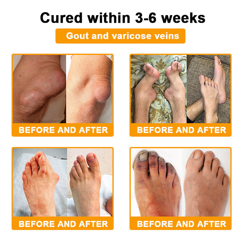 AllyBee™ Botulinum Toxin & Bee Venom Pain-Relief Bone Healing Cream