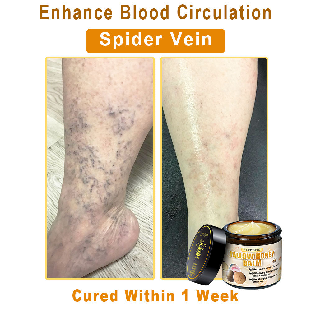YSMYSM® Bee Venom and Tallow Comprehensive Cream: Anti-Aging, Hydration, Skin Repair, Even Tone, Acne & Dark Spot Treatment, Wart & Mole Removal, Psoriasis Relief