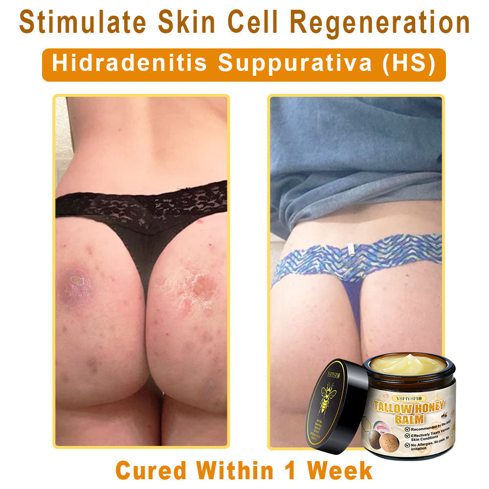 YSMYSM® Bee Venom and Tallow Comprehensive Cream: Anti-Aging, Hydration, Skin Repair, Even Tone, Acne & Dark Spot Treatment, Wart & Mole Removal, Psoriasis Relief