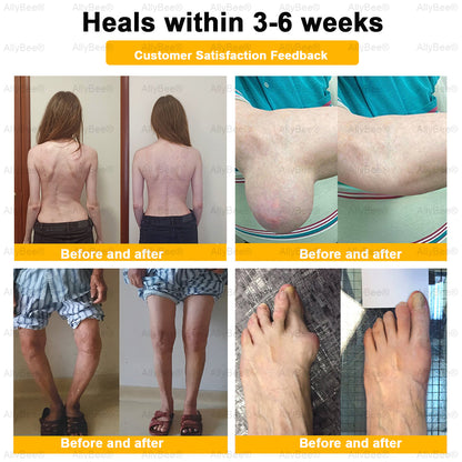 AllyBee™ Botulinum Toxin & Bee Venom Pain-Relief Bone Healing Cream