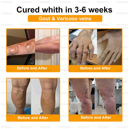 AllyBee™ Botulinum Toxin & Bee Venom Pain-Relief Bone Healing Cream