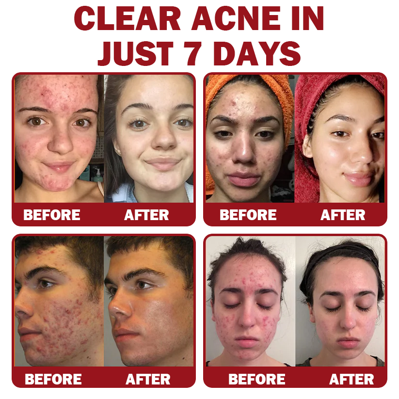 Only 5 jars! Grab an exclusive 50% discount now! Keep your skin youthful and glowing in just 1 to 4 weeks. Don’t miss your chance—this offer won’t come around again until next year. Act fast! 180-day money back guarantee!